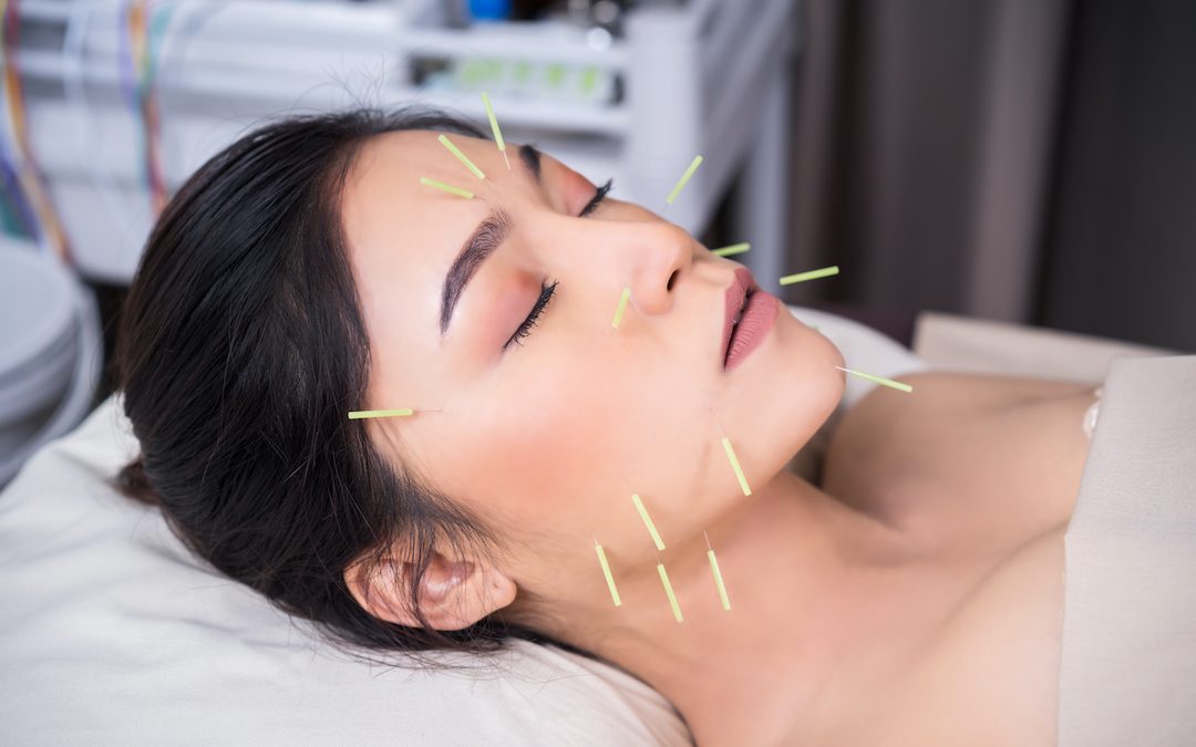 Dry Needling vs. Acupuncture: What’s the Difference?