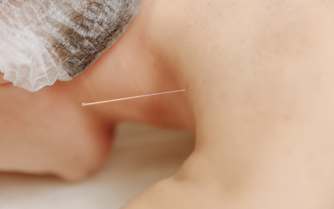 Benefits Of Having Acupuncture Regularly