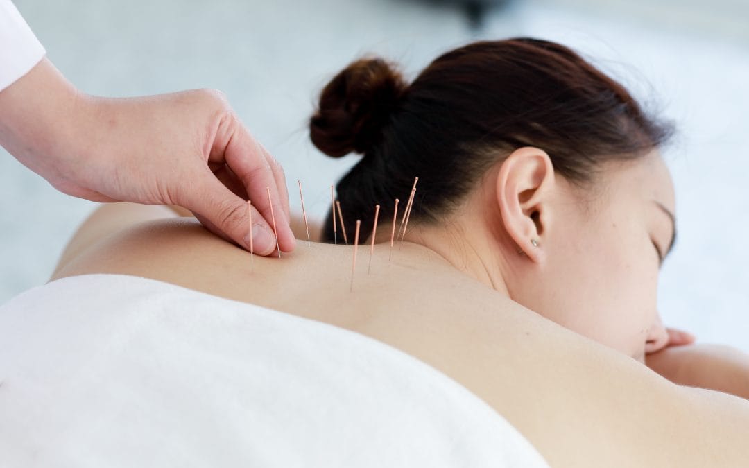 A person receiving acupuncture needles in their upper back while lying face down on a massage table.