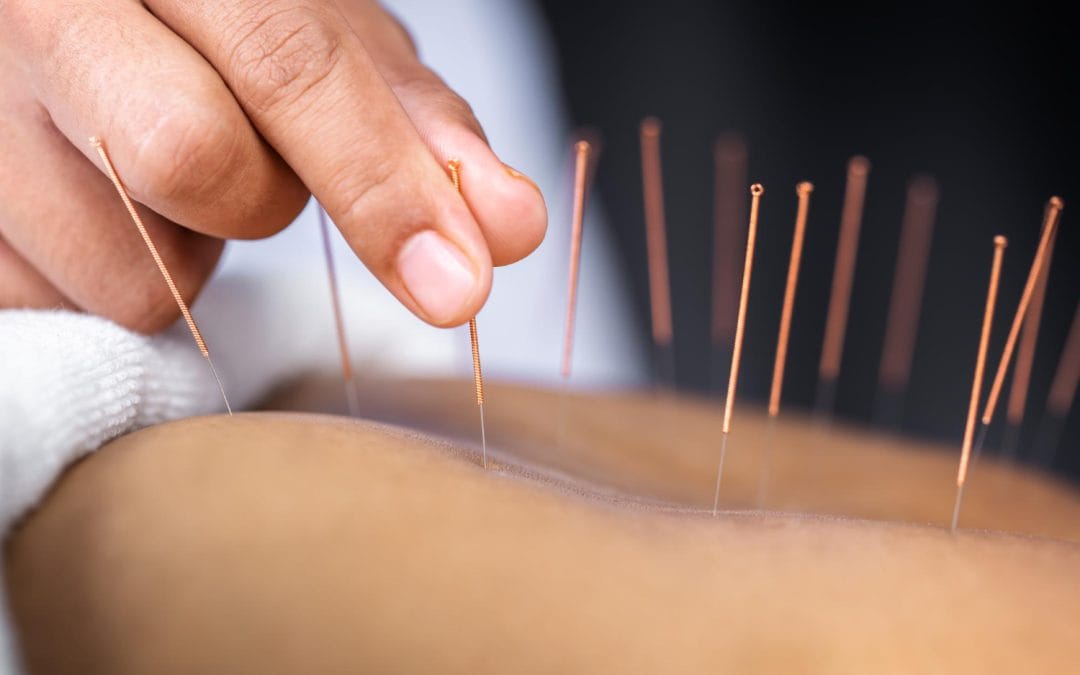 Close-up of a person's hand inserting acupuncture needles into someone's skin during treatment.
