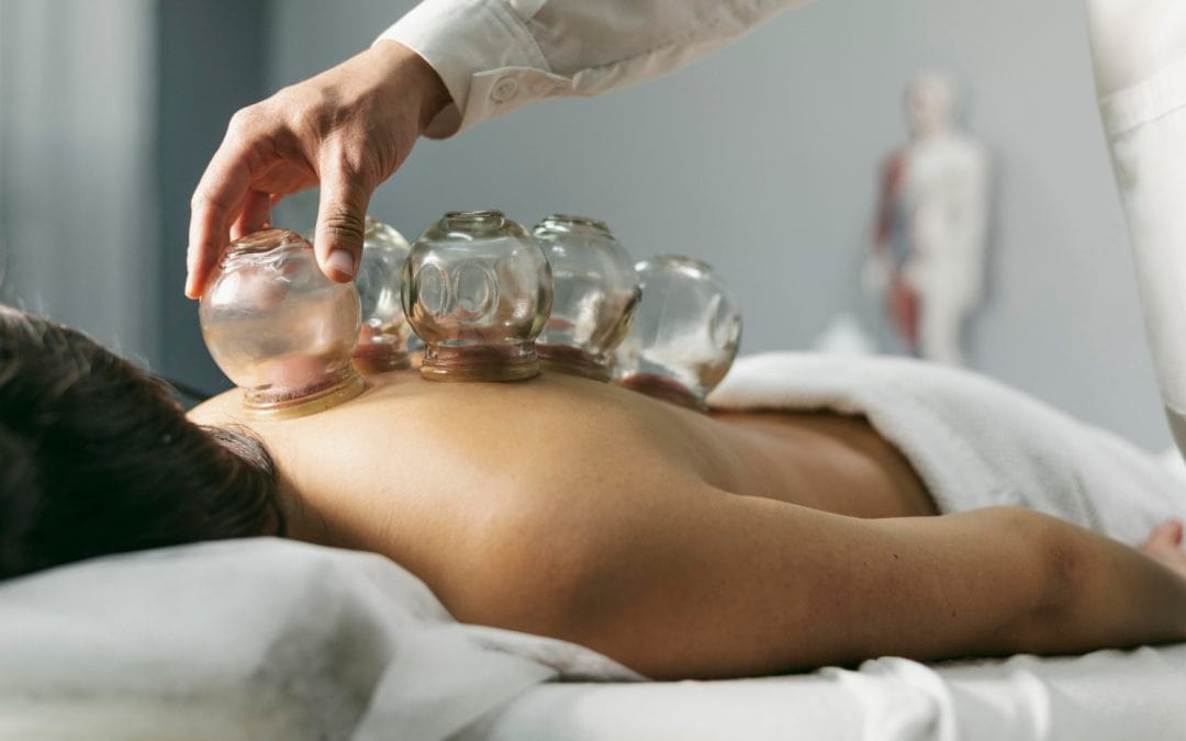 A person receives cupping therapy with glass cups placed on their bare back in a clinic setting.