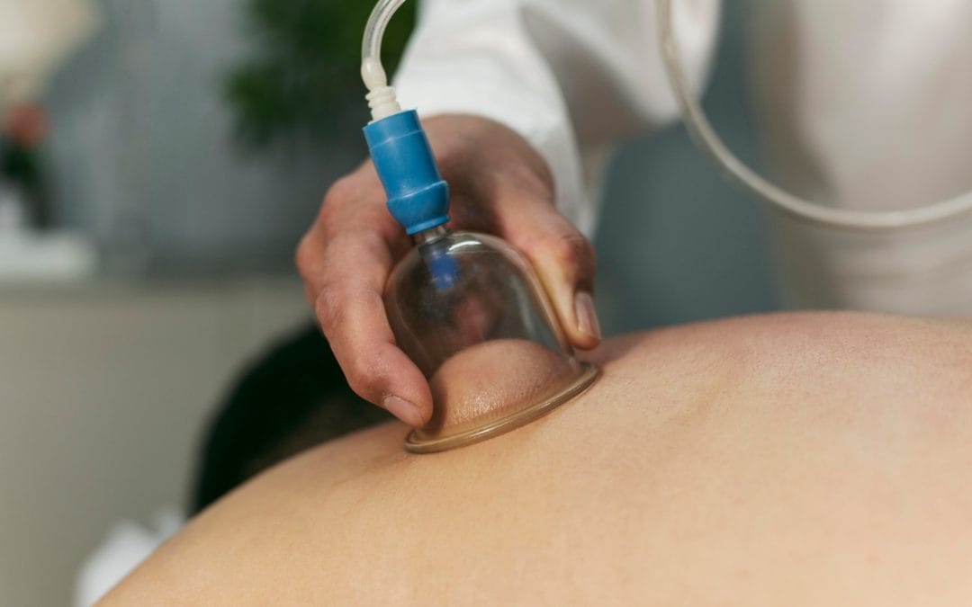 A therapist performs cupping therapy on a person's back using a glass suction cup.